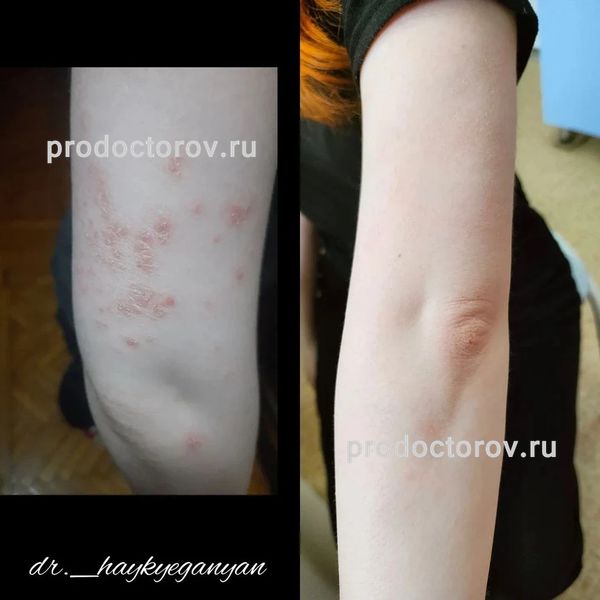 Еганян Айк Сосович, дерматолог - 78 отзывов | Электросталь - ПроДокторов