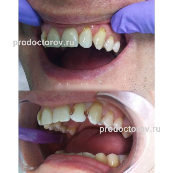 Бочкарева В. В. - Лечение кариеса зубов 2.1, 2.2 и 2.3