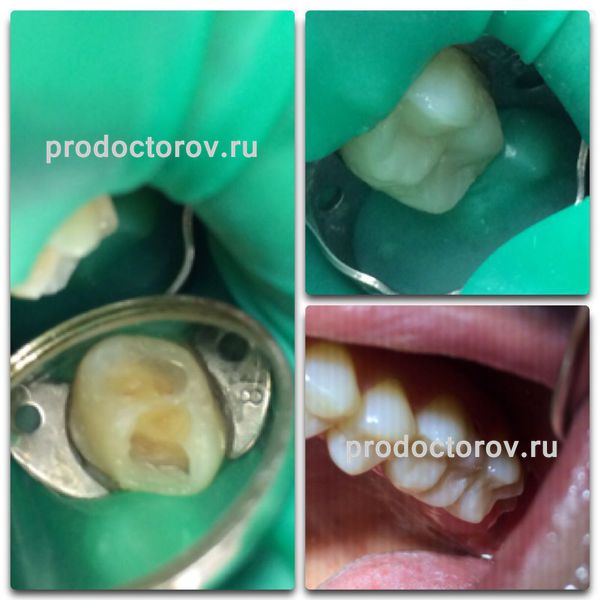 Строева Е. В. - Восстановление зуба