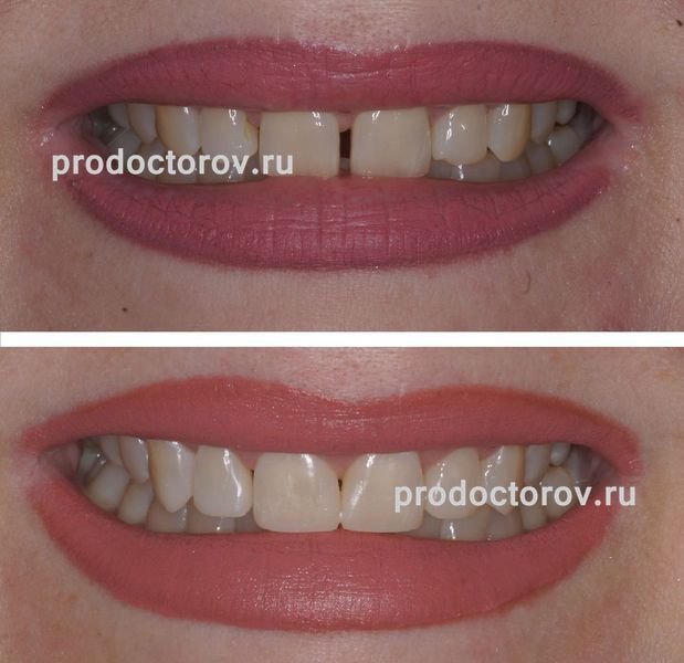 Каширцева В. С. - Реставрации 1.3-2.3 зубов