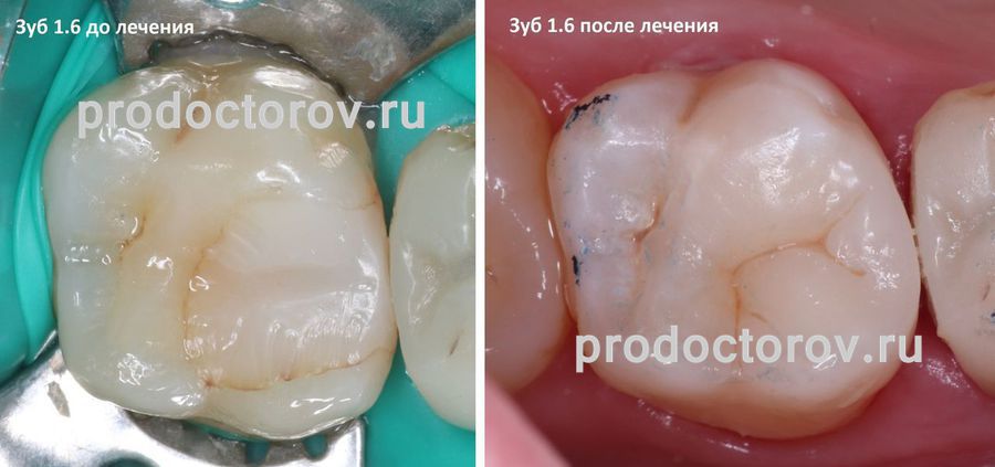 Каширцева В. С. - Реставрации 1.6 зуба