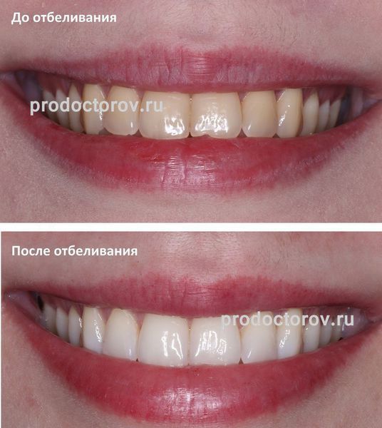 Каширцева В. С. - Домашнее отбеливание зубов