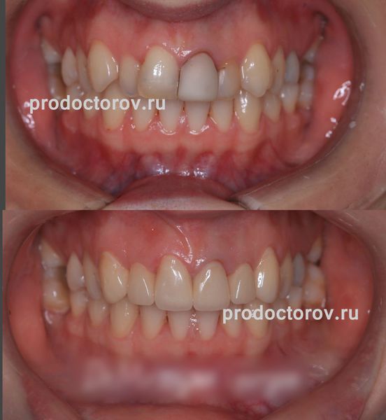 Мирзоян Г. В. - Установили пациенту  6 керамических виниров. Подобрали цвет и форму зубов 