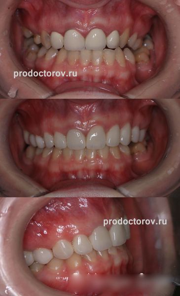 Мирзоян Г. В. - Заменили старые металло-керамические коронки на новые безметаловые(E-max) виниры 12 зубов  