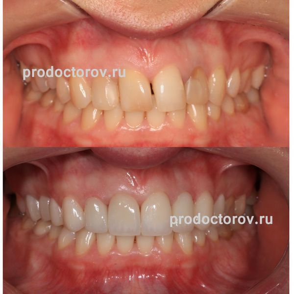Мирзоян Г. В. - Протезирование верхней челюсти , с  помощью Керамических Виниров
