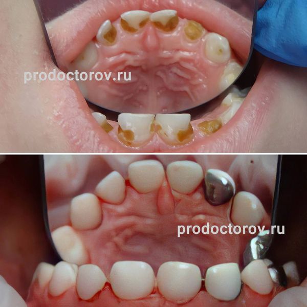 Прививкова Д. И. - Реставрации и коронки на молочные зубы 