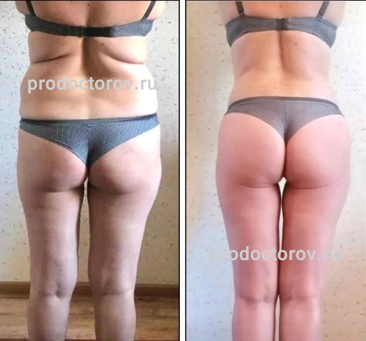 самир седышев абдоминопластика. седушев абдоминопластика. седышев самир хасанович. живот после родов голая. седышев самир пластический хирург.