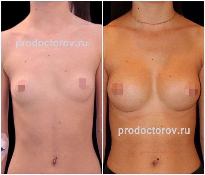 Диков Ю. Ю. - Увеличение груди анатомическими имплантами 215 мл