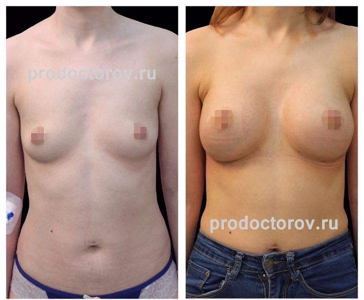 Диков Ю. Ю. - Увеличение груди анатомическими имплантами 295 мл