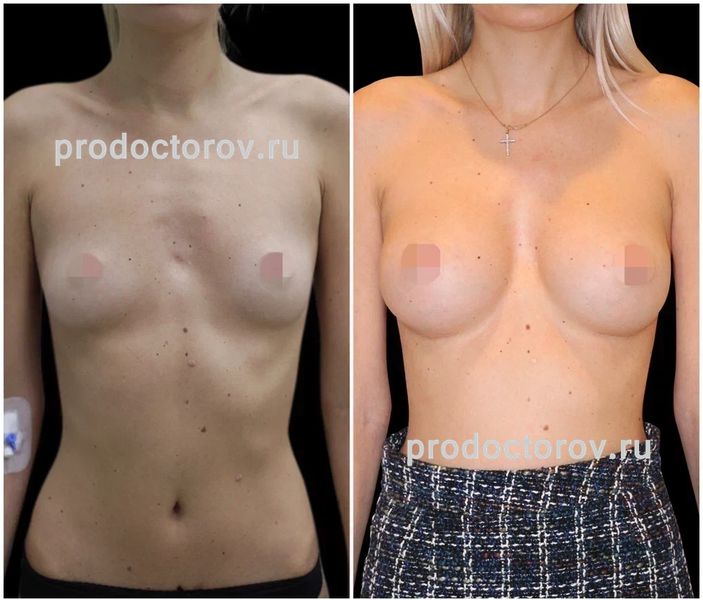 Диков Ю. Ю. - Увеличение груди анатомическими имплантами 330 мл