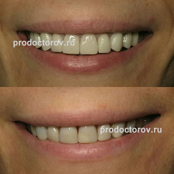 Шаповалов А. С. - Тотальное протезирование зубов металлокерамическими коронками