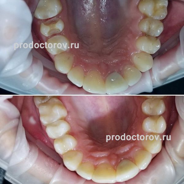 Шаповалов А. С. - Керамическая вкладка emax, пломбы рядом стоящих зубов