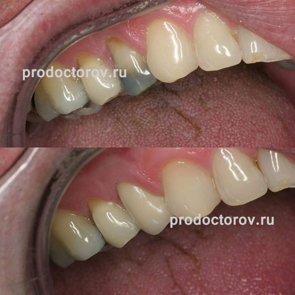 Шаповалов А. С. - Керамическая коронка emax, с предварительным лечение зуба