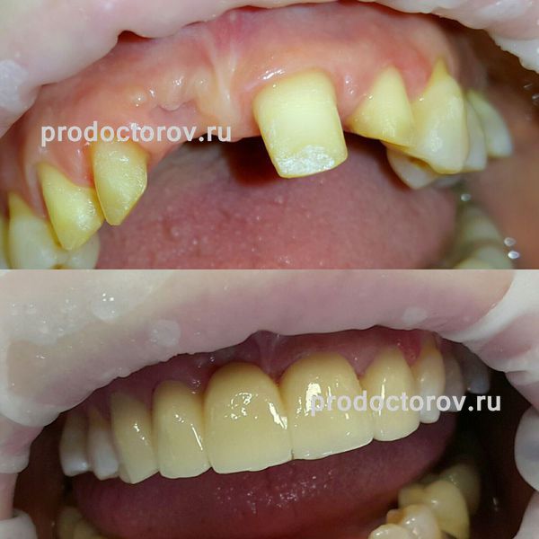 Шаповалов А. С. - Протезирование коронками (исправление формы зубов)