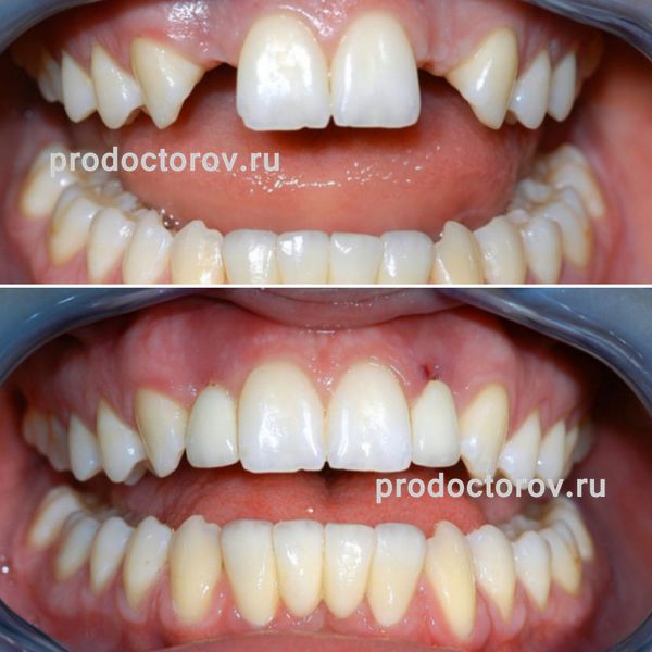 Шаповалов А. С. - имплантация и протезирование в зоне улыбки