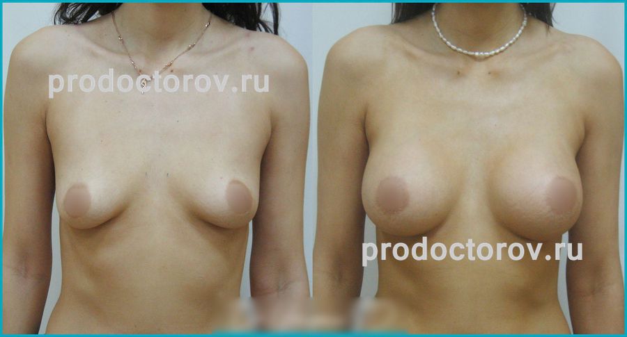 Юсупов С. Д. - Увеличение груди