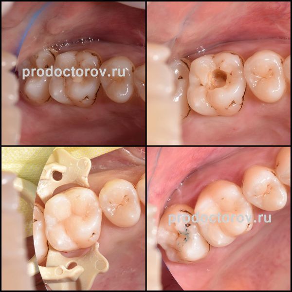 Менажиева М. В. - лечение кариеса зубов
