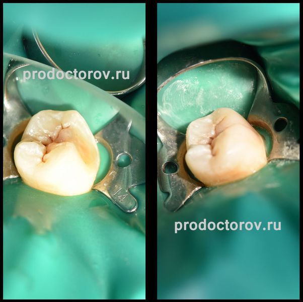 Менажиева М. В. - лечение кариеса зубов