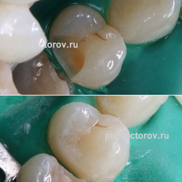 Иванова В. В. - Лечение кариеса под микроскопом с восстановлением анатомической формы зуба