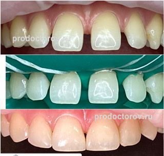 Арутюнян М. Г. - Прямая реставрация всех фронтальных зубов ( закрытие трем, диастемы )