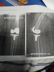 Эндопротезирование коленного сустава новосибирск отзывы форум