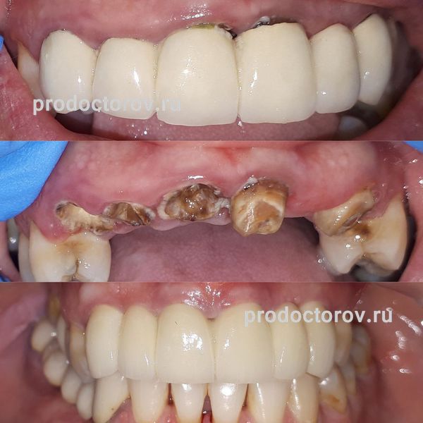Ибрагимов Р. Д. - разрушенные зубы под металлокерамическими коронками заменены на импланты