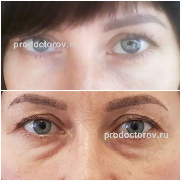 Шамин В. П. - Устранение мешков под глазами (нижняя блефаропластика) после и до (срок неделя)