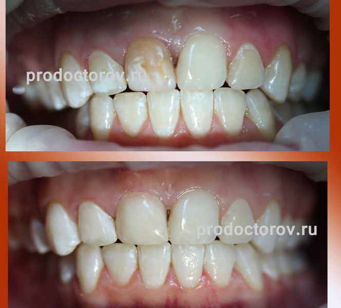 Рябикова Т. А. - Отбеливание и эстетическое восстановление зуба
