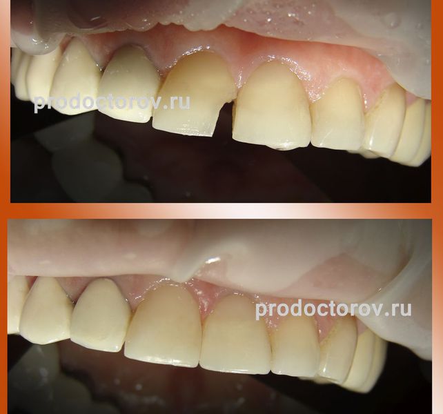 Рябикова Т. А. - Реставрация коронки зуба ( скол зуба)