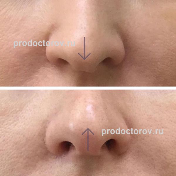 Каюшкина И. Г. - Коррекция носа с использованием Ксеомин и Radiesse
