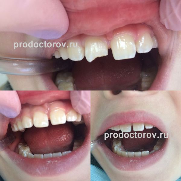 Любенко О. А. - Реставрация зуба после травмы