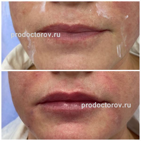 Солдатенко Н. Н. - Контурная коррекция губ с целью восстановления обьем и коррекции асимметрии. 