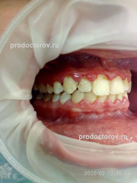 Лечение пародонтоза Томск Тимакова стоматология томск томдент на фрунзе