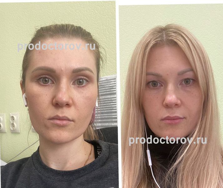 Пластический хирург ибрагимов. Подтяжка век. Операция по феминизации лица. Пластическая операция уфа. Смас лифтинг верхних век.