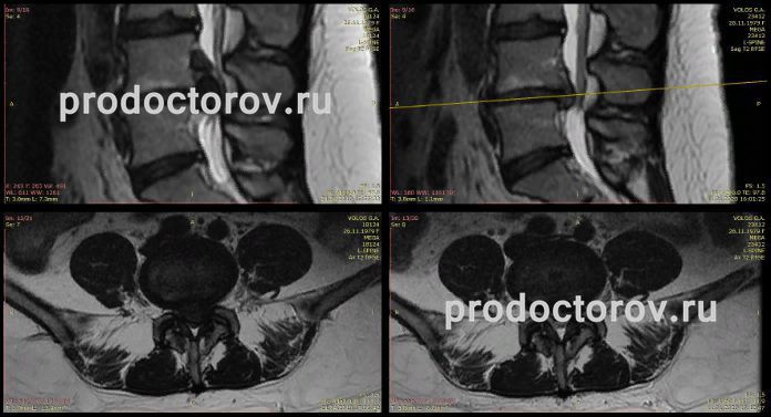 Клиническая картина компрессии корешков конского хвоста отличается от компрессии конуса и конуса