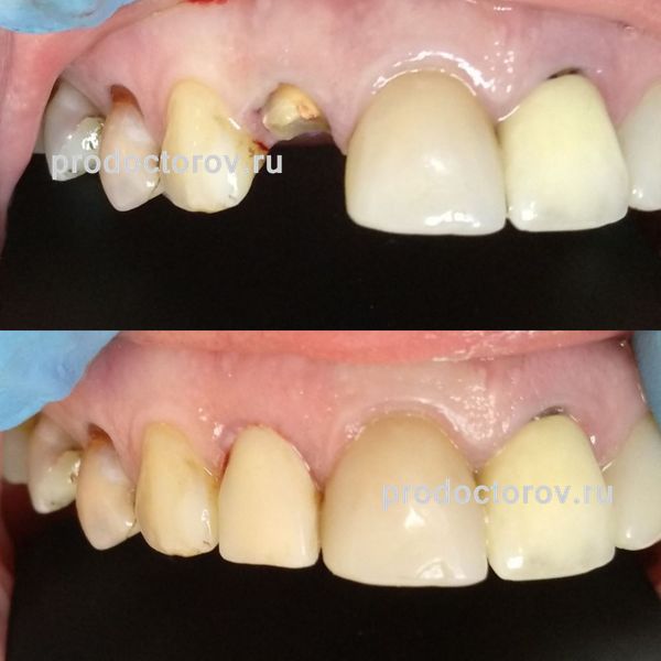Вусатая Е. В. - Реставрация переднего зуба