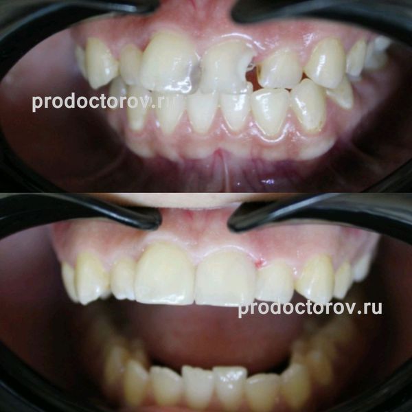 Вусатая Е. В. - Лечение кариеса передних зубов